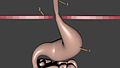 File:Hernia de hiato.ogg