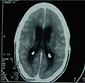 Tuberculous-meningitis-scan.jpg