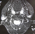Parotid-gland-tuberculosis.jpg