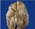 Tuberculous-meningitis-autopsy.jpg