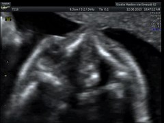 File:Fetal cataract.ogv